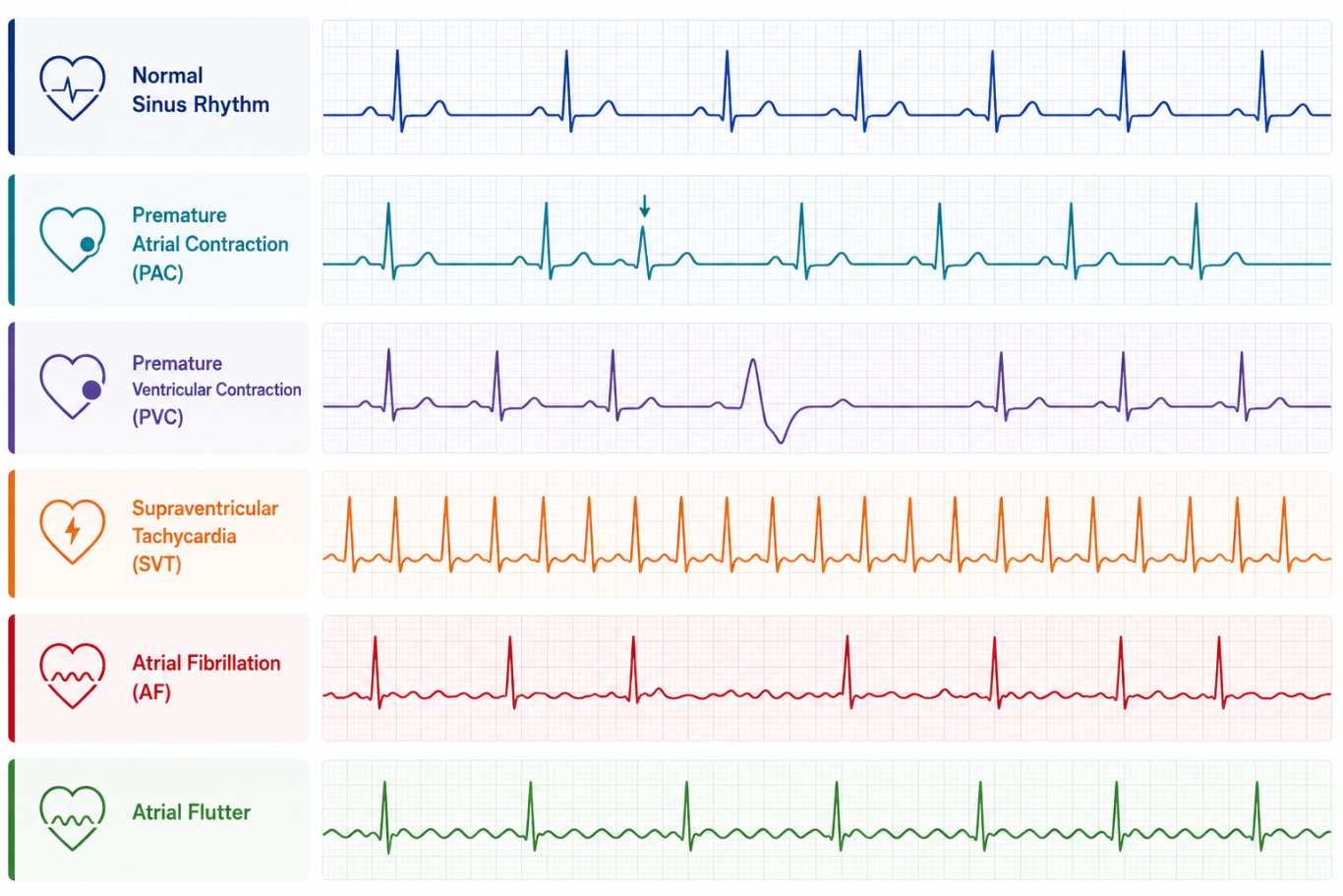Various heart rhythm patterns displayed in colour-coded lines, illustrating different conditions.